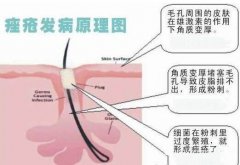 痤瘡治療的誤區(qū)有什么？痤瘡的治療要警惕哪些