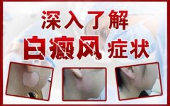 白癜風(fēng)的初期癥狀是什么？怎么治療？
