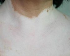 白癜風(fēng)癥狀，白癜風(fēng)晚期會(huì)有的癥狀